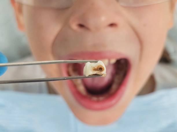 Best Emergency Wisdom Teeth Removal in Meridian, PA